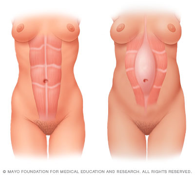 diastasis rectii