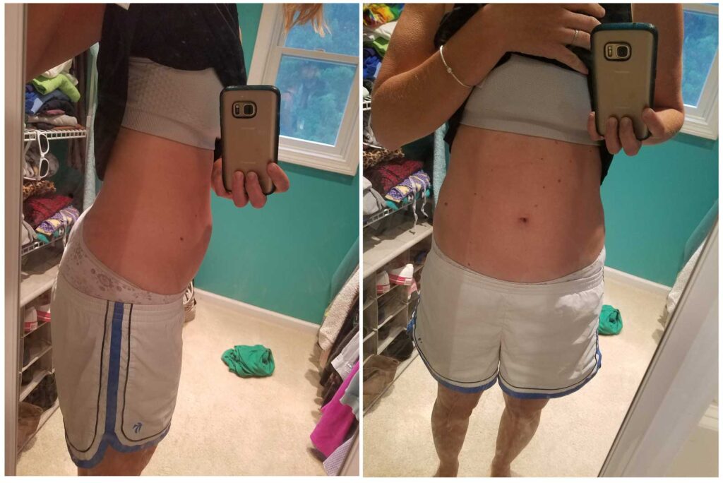 Postpartum belly with diastasis recti and hernia