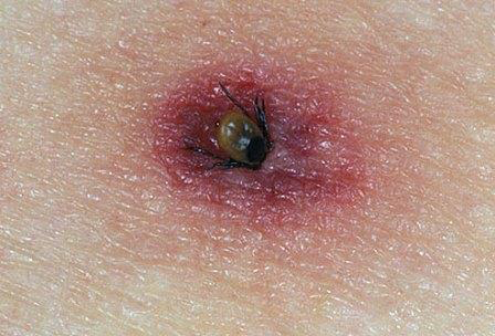 Image of tick burrowing